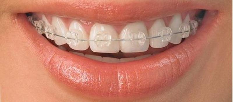 Ortodoncia estética: alternativas modernas a los brackets metálicos