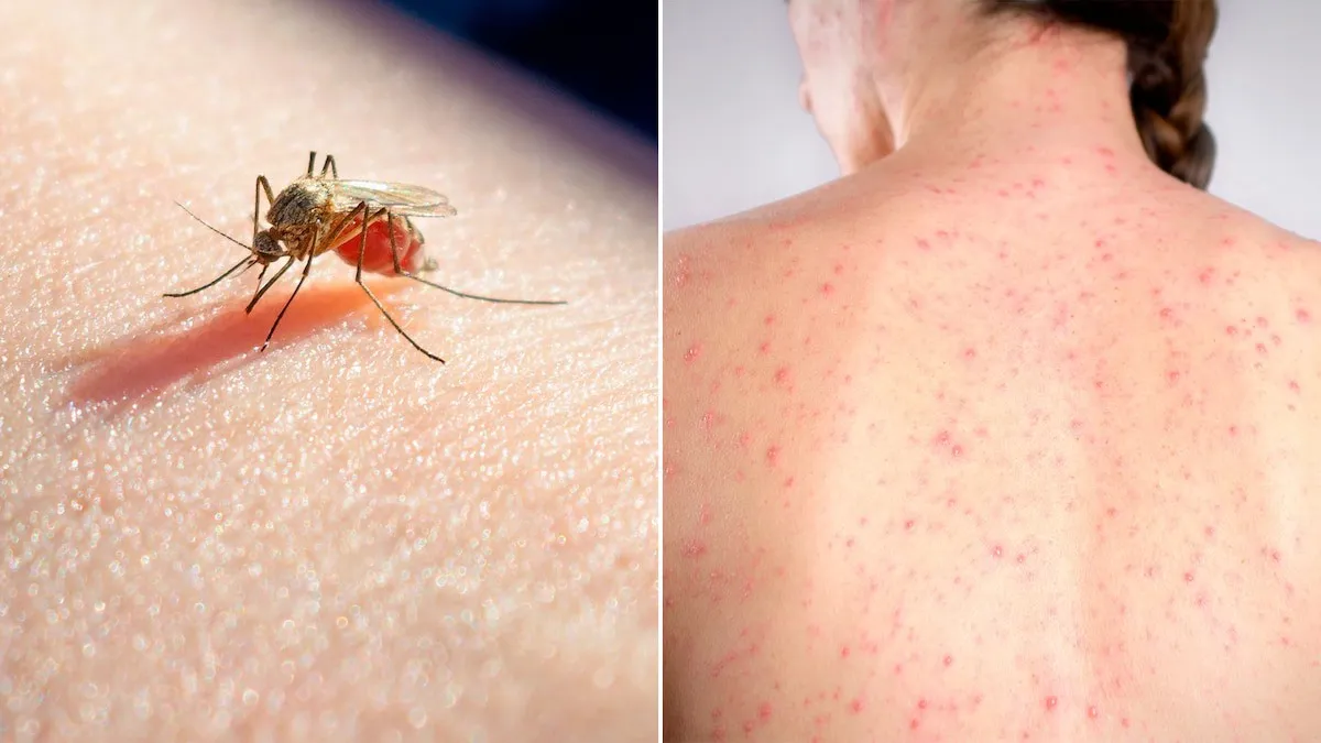 Situación Epidemiológica en Quilmes: ¿Cuántos casos de sarampión y dengue hay?